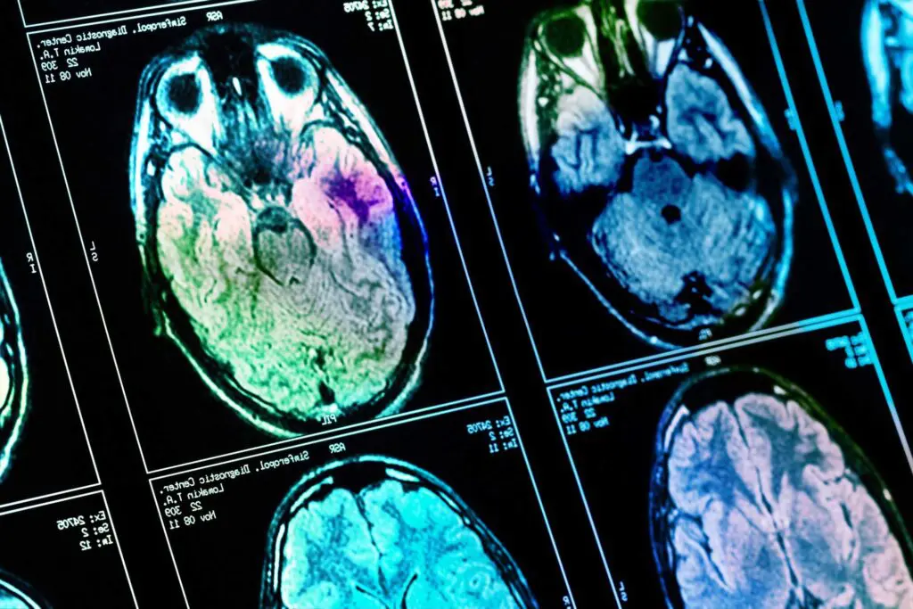 What is traumatic brain injury (TBI)?